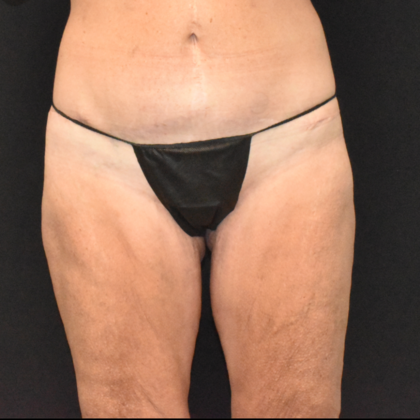 Torsoplasty: Case 1 - After