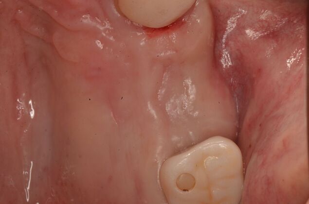 Dental Implants Case 61