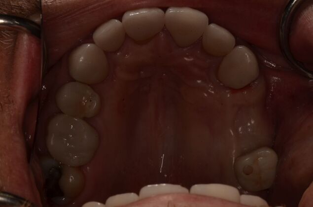 Dental Implants: Case 61 - Before three dental implants