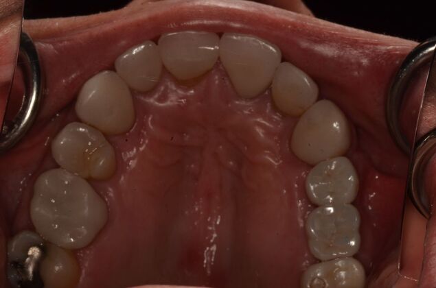 Dental Implants: Case 61 - After with three dental implants with screw retained crowns