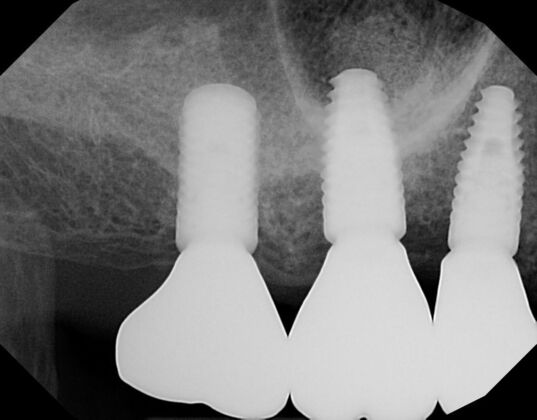 Dental Implants: Case 61 - After three dental implants with Zirconium screw retained crowns