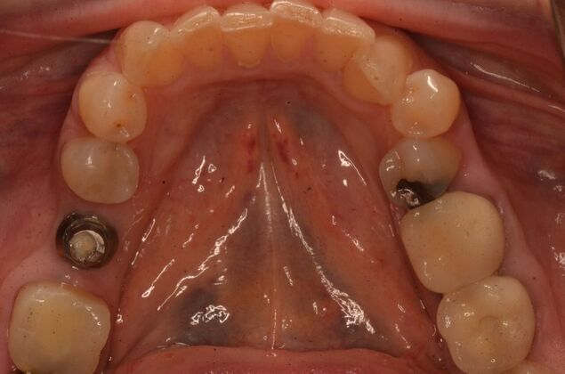 Dental Implants Case 62 - Before