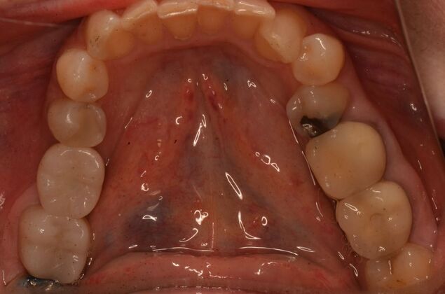 Dental Implants Case 62 - After