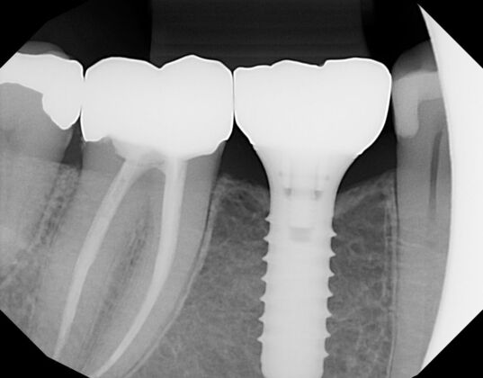 Dental Implants: Case 62 - After with new implant crown and new crown on root canal tooth