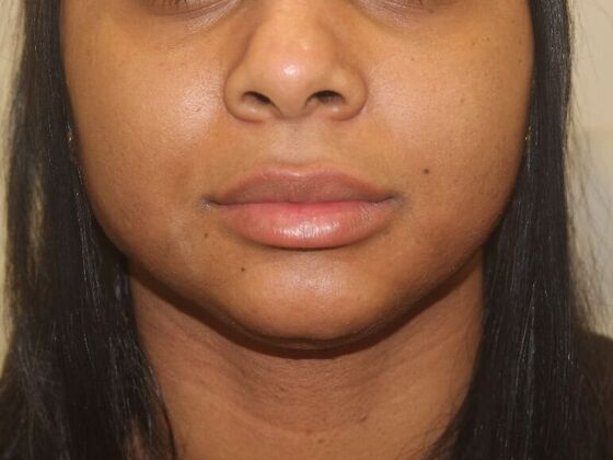 Injectables Case 72 - Before