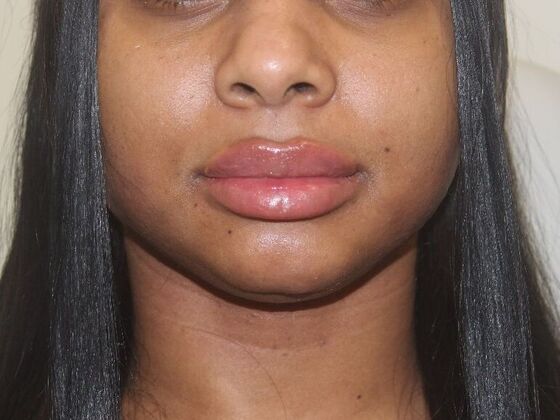 Injectables Case 72 - After