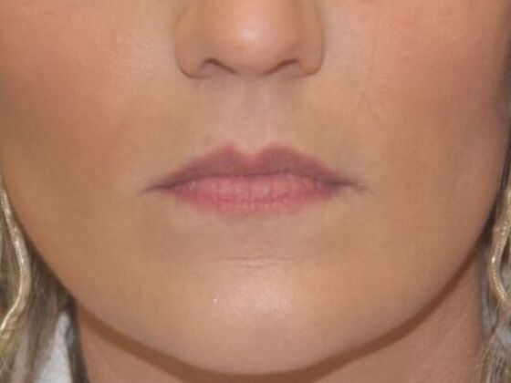 Injectables Case 73 - Before