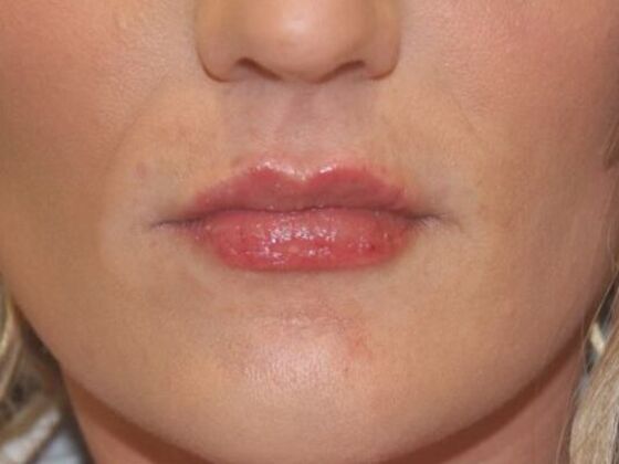 Injectables Case 73 - After