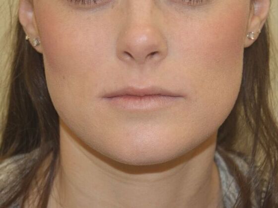 Injectables Case 74 - Before