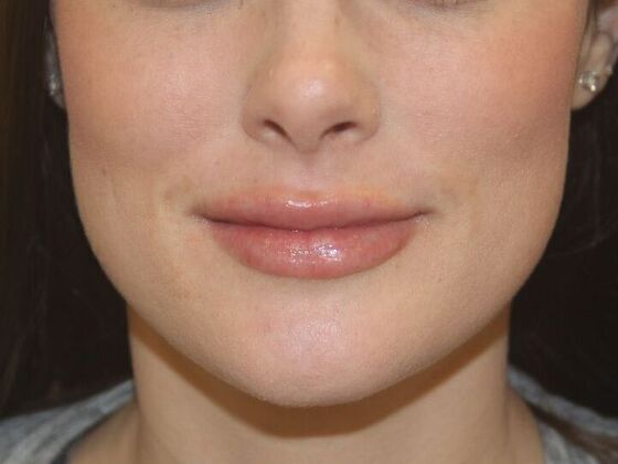 Injectables Case 74 - After