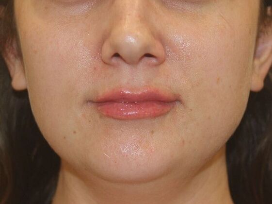 Injectables Case 75 - Before