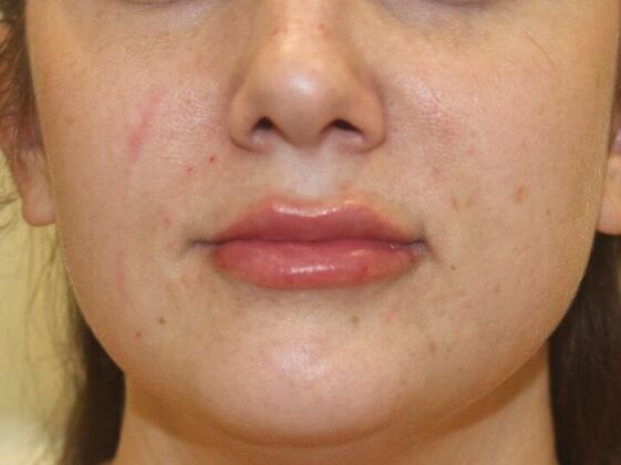 Injectables Case 75 - After