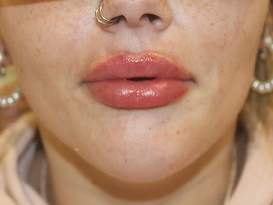 Injectables Case 76 - After