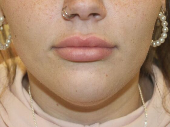 Injectables Case 76 - Before