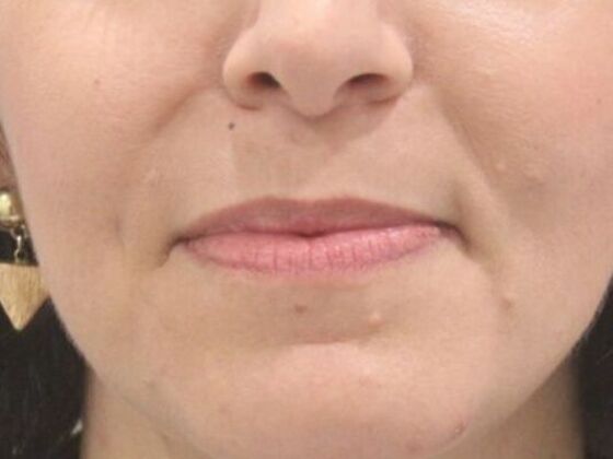 Injectables Case 77 - Before