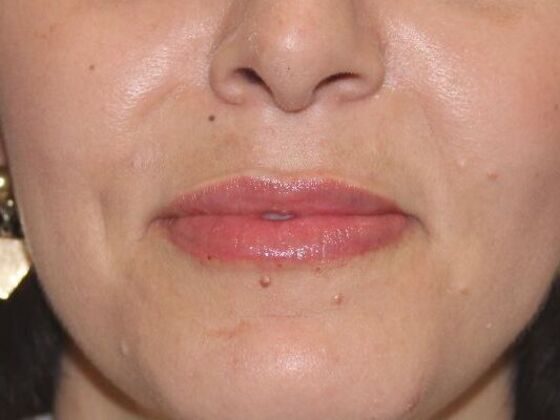 Injectables Case 77 - After