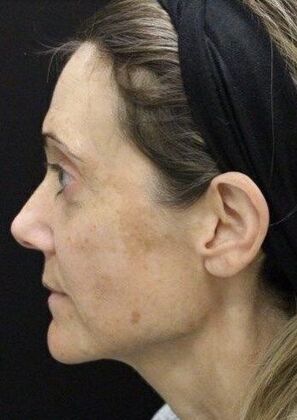 Skin Treatments: Case 8 - Before