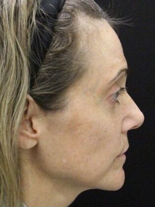 Skin Treatments: Case 8 - Before