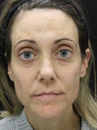 Skin Treatments Case 8 - Before