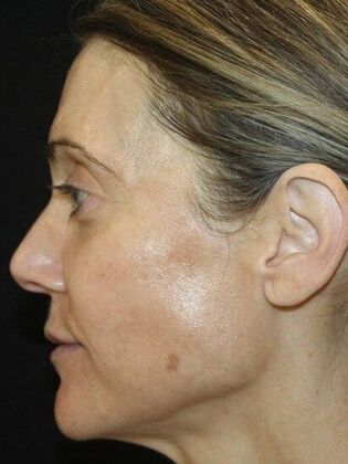Skin Treatments: Case 8 - After