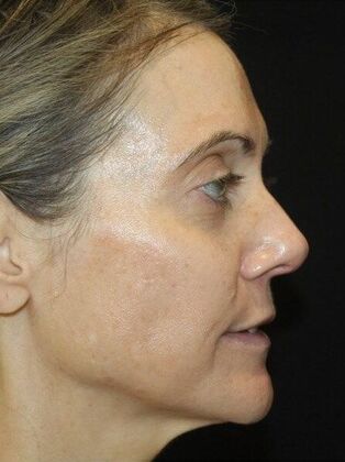Skin Treatments: Case 8 - After