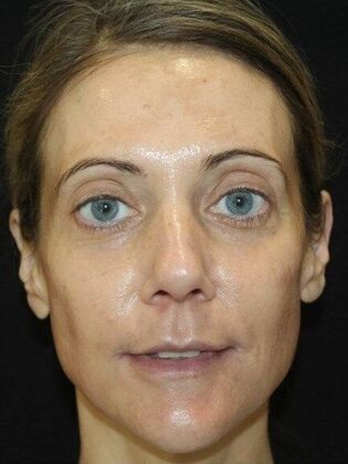 Skin Treatments Case 8 - After