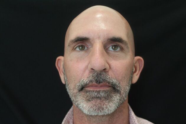 Skin Treatments Case 9 - After