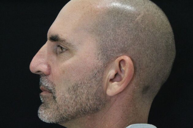 Skin Treatments: Case 9 - Before