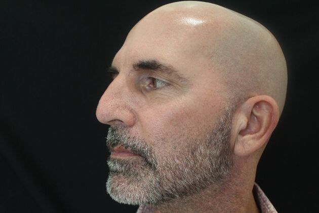 Skin Treatments: Case 9 - After