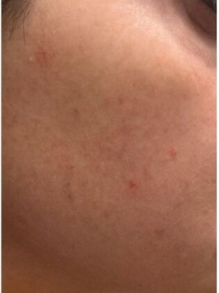 Skin Treatments Case 10 - Before