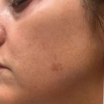 Skin Treatments: Case 10 - Before