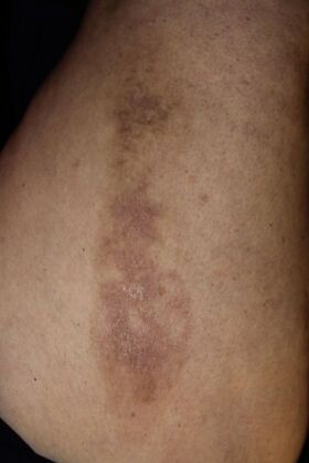 Skin Treatments: Case 10 - Before