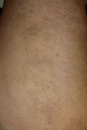 Skin Treatments: Case 10 - After