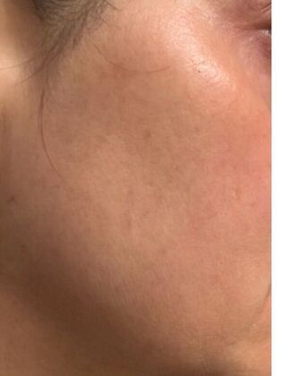 Skin Treatments Case 10 - After