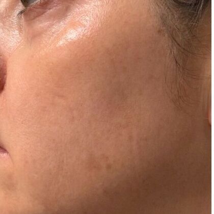Skin Treatments: Case 10 - After