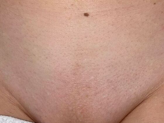 Skin Treatments Case 11 - After