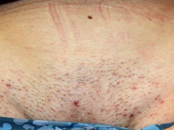 Skin Treatments Case 11 - Before