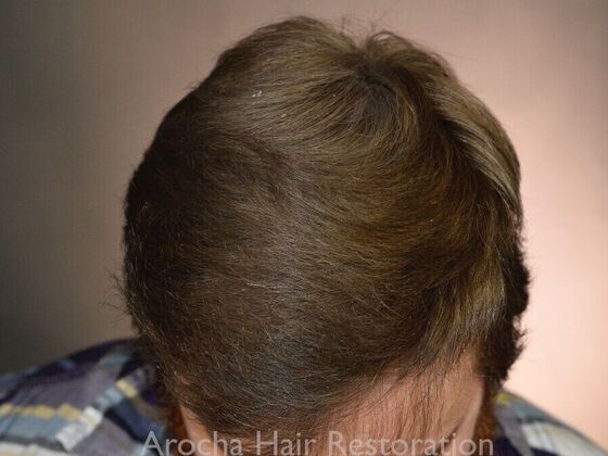 FUT Hair Restoration: Case 35 - After