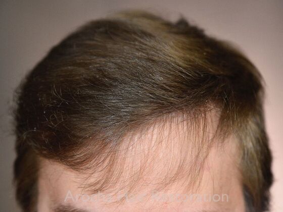FUT Hair Restoration Case 35 - After