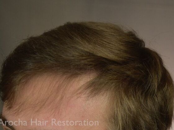 FUT Hair Restoration: Case 35 - After