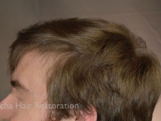 FUT Hair Restoration: Case 35 - After