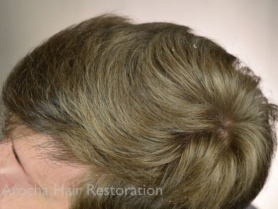 FUT Hair Restoration: Case 35 - After