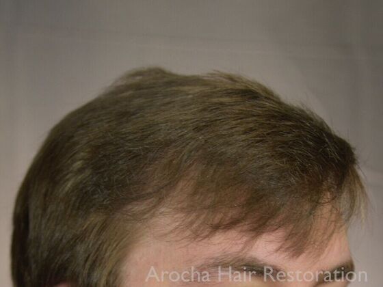 FUT Hair Restoration: Case 35 - After