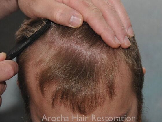 FUT Hair Restoration: Case 35 - Before