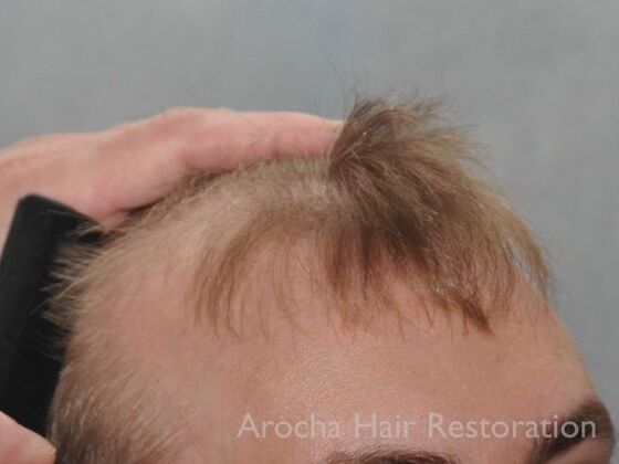 FUT Hair Restoration: Case 35 - Before