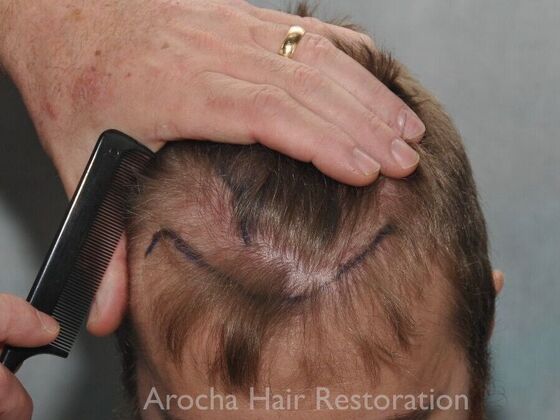 FUT Hair Restoration Case 35 - Before