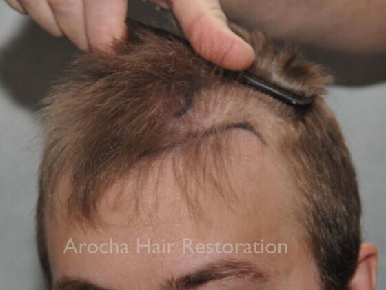 FUT Hair Restoration: Case 35 - Before