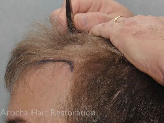 FUT Hair Restoration: Case 35 - Before