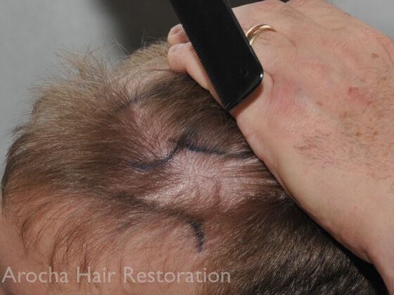 FUT Hair Restoration: Case 35 - Before