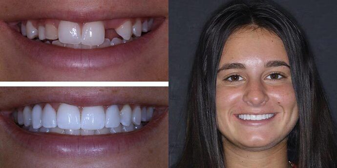 Dental Implants Cases